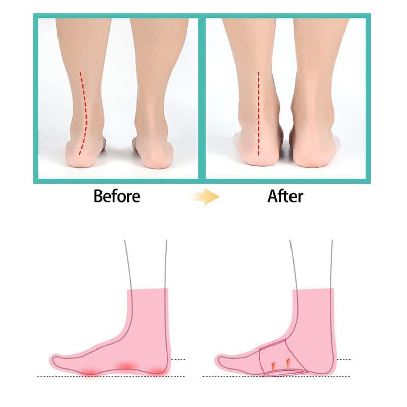 2 Pcs Foot Arch Support Flat Foot Insoles For Flat Feet Orthopedic Pad Flat Insole Flat Foot Corrector Plantar Fasciitis Support